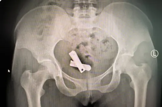 magen de rayos X que muestra un corta&uacute;&ntilde;as insertado dentro de un &uacute;tero, Mekele, Tigray, marzo de 2025. (Xposure)