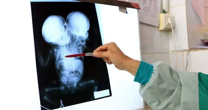 En la imagen de AFP, una radiografía de los siameses.