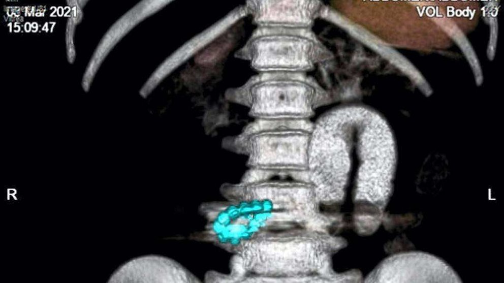 Una imagen de rayos X de la pequeña Althea Faye Barabacina con once imanes en sus intestinos. (Medeor Hospital)