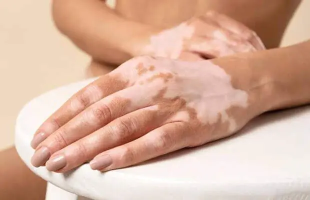 El vitiligo es una  enfermedad cr&oacute;nica causada por la p&eacute;rdida de pigmento debido a un ataque del sistema inmunitario. (Fuente externa)