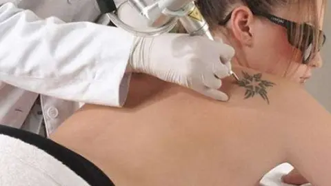 La eliminación de tatuajes se realiza en Jumeirah Beach Road.