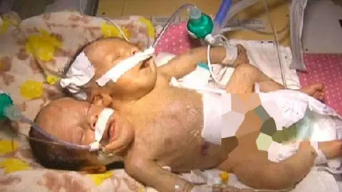 Los beb&eacute;s siameses nacidos en Yemen.