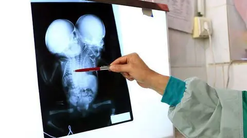 En la imagen de AFP, una radiografía de los siameses.