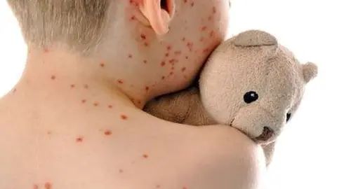 Niño con sarampión ( Imagen ilustrativa- Fotolia.com)