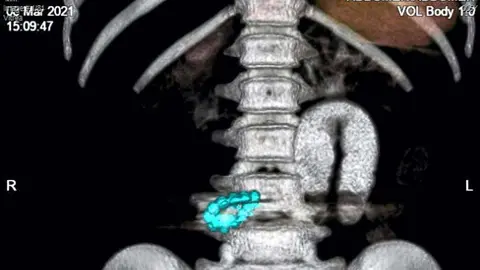 Una imagen de rayos X de la pequeña Althea Faye Barabacina con once imanes en sus intestinos. (Medeor Hospital)