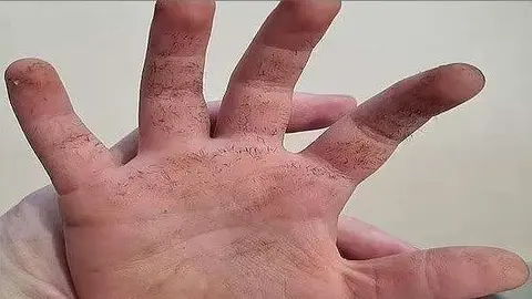 La mano del niño cubierta de dolorosas y tóxicas espinas. (Daily Mail)