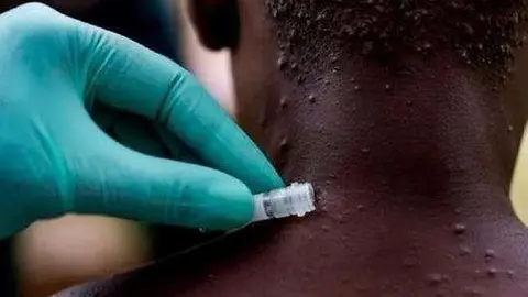 Una toma de muestra de probable infectado por viruela del mono. (Fuente externa)