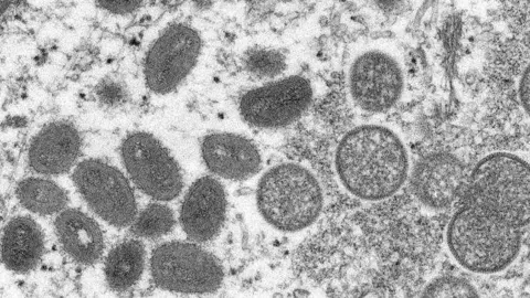 Una imagen de microscopía electrónica (EM) muestra partículas maduras del virus de la viruela del mono. (Fuente externa)