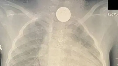 La radiografía muestra la moneda en el interior de la pequeña. (Gulf Today)