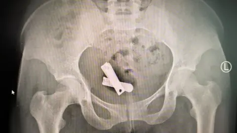 magen de rayos X que muestra un corta&uacute;&ntilde;as insertado dentro de un &uacute;tero, Mekele, Tigray, marzo de 2025. (Xposure)