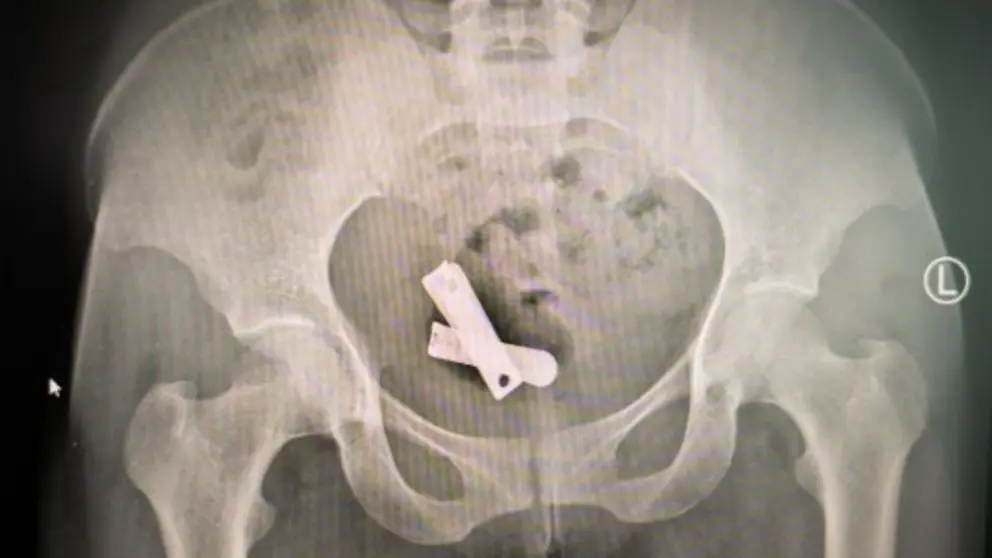 magen de rayos X que muestra un corta&uacute;&ntilde;as insertado dentro de un &uacute;tero, Mekele, Tigray, marzo de 2025. (Xposure)