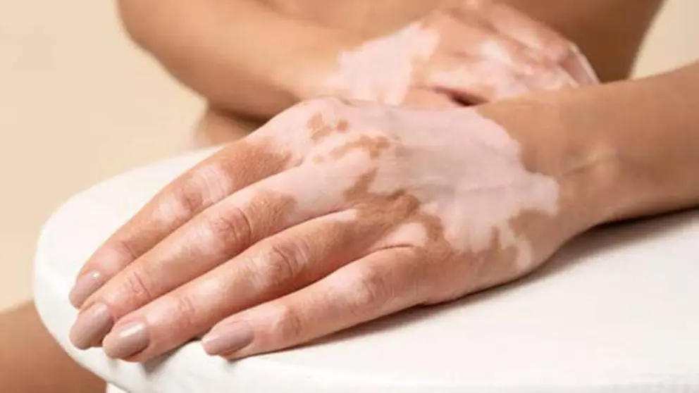 El vitiligo es una  enfermedad cr&oacute;nica causada por la p&eacute;rdida de pigmento debido a un ataque del sistema inmunitario. (Fuente externa)